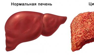Ciroza jetre 4. stadij, koliko žive, simptomi i liječenje