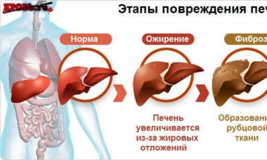 Krvarenje kod ciroze jetre