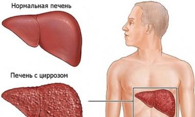 Znakovi ciroze jetre, simptomi i liječenje