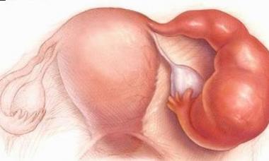 Inflammation des trompes de Fallope et des ovaires, causes, traitement