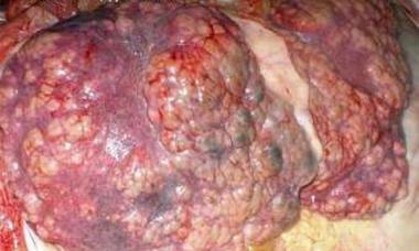 Principaux stades de la cirrhose du foie : signes et pronostic de survie